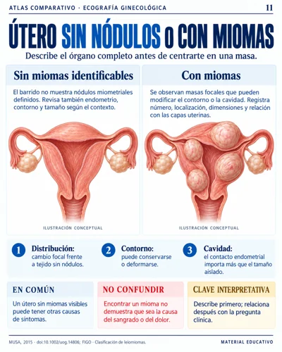 Útero sin nódulos o con miomas